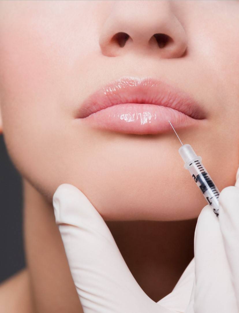 Lip filler behandeling in Amersfoort en omgeving